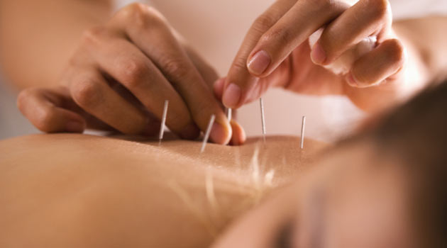 acupuncture