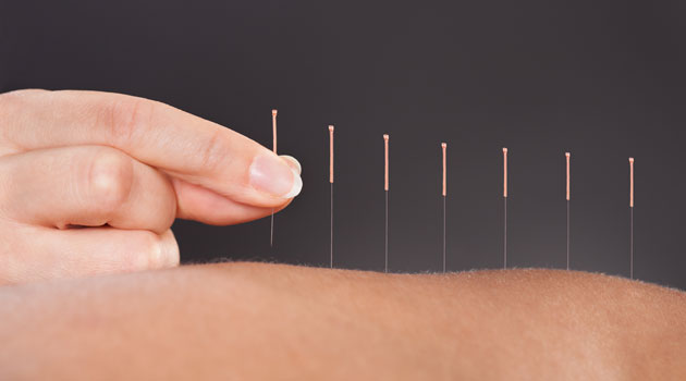 acupuncture
